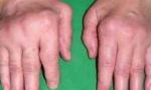 Ревматоидный артрит симптомы лечение