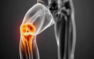 Гонартроз коленного сустава симптомы лечение