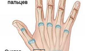 Почему боли в суставах пальцев рук при сгибании