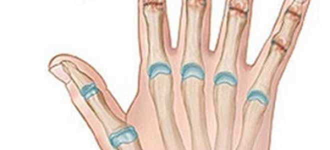Почему боли в суставах пальцев рук при сгибании