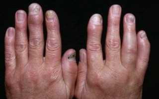 Чем лечить полиартрит на руках