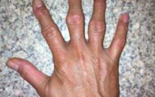 Как лечить воспаление суставов пальцев рук