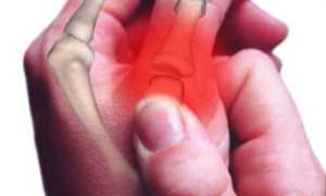 Артрит большого пальца руки: симптомы и лечение